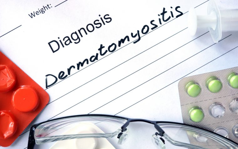 Resunab for dermatomyositis